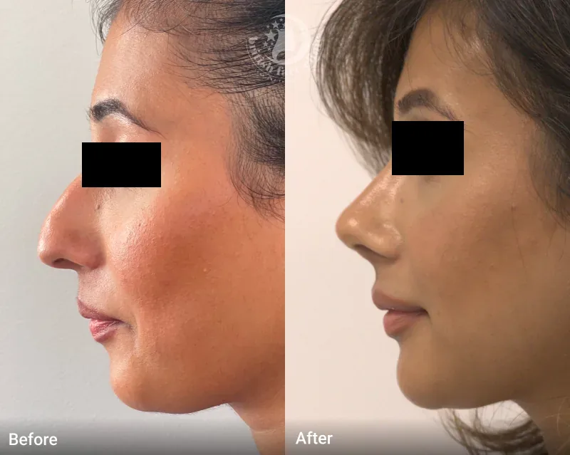 Rhinoplasty patient before and after, view 1 of 5