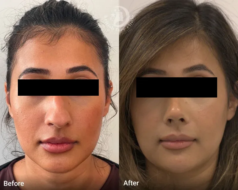 Rhinoplasty patient before and after, view 3 of 5