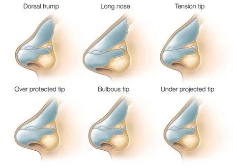 Illustrations of common nasal shapes: dorsal hump, long nose, tension tip, over-projected tip, bulbous tip and under-projected tip